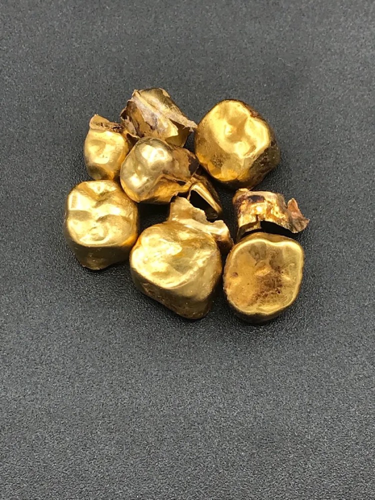 歯科金・金歯